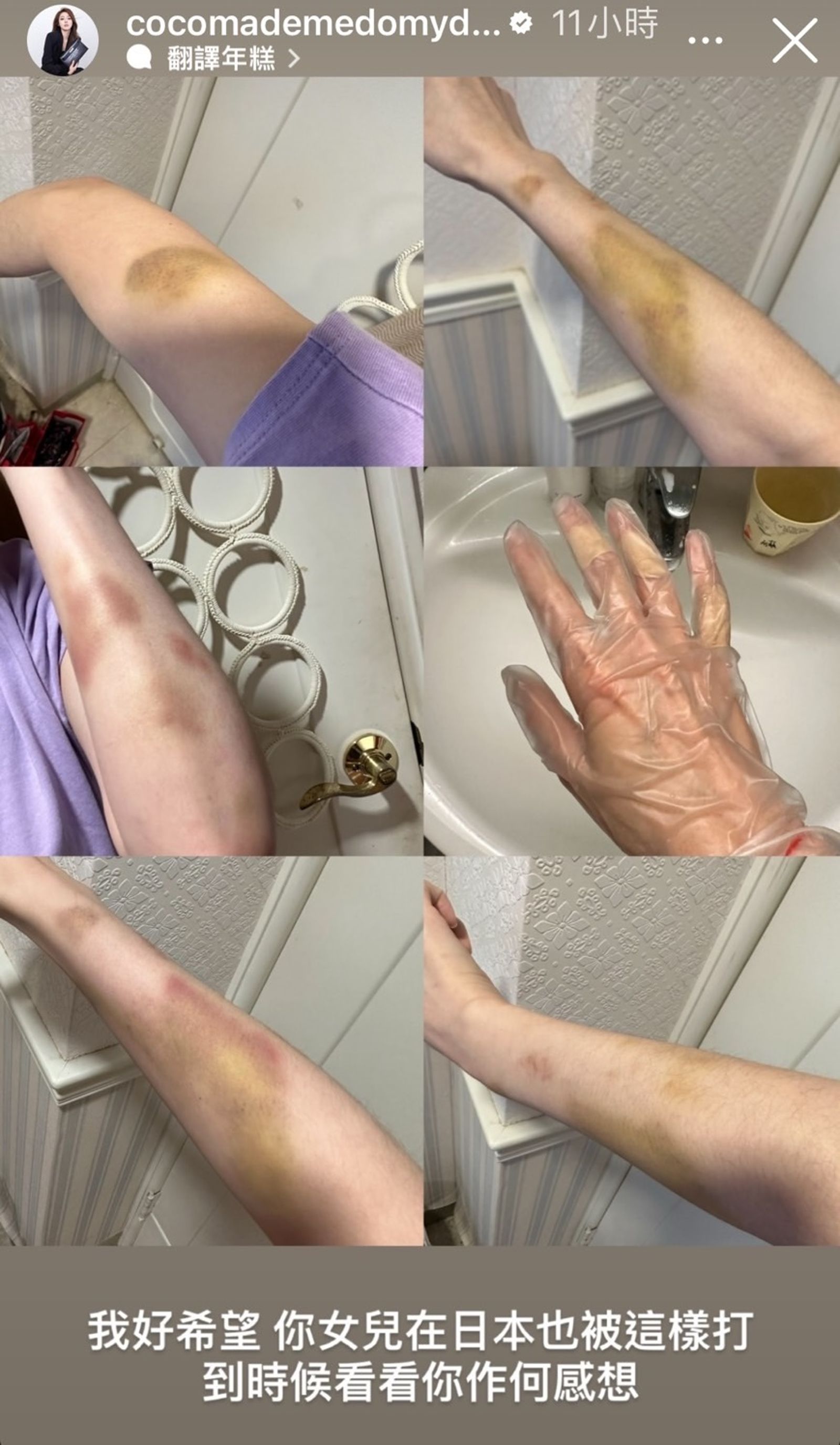 林千又連發IG限動細數男友罪狀,公布自己滿身是傷的照片為證。(圖/翻攝自林千又IG)