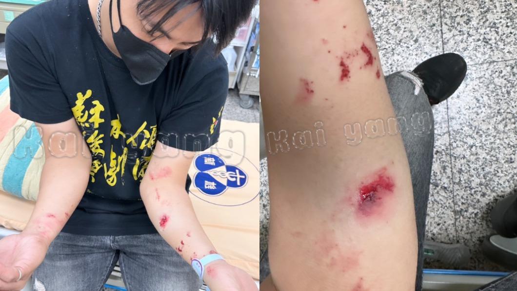 余凱揚雙手被炸傷,大大小小傷口遍布,另外雙耳也一度聽不見。(圖/余凱揚提供)