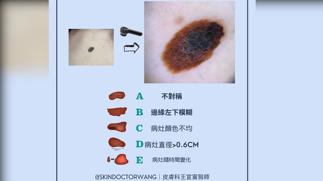 ABCDE檢查規則。（圖／翻攝自王宣甯醫師臉書）