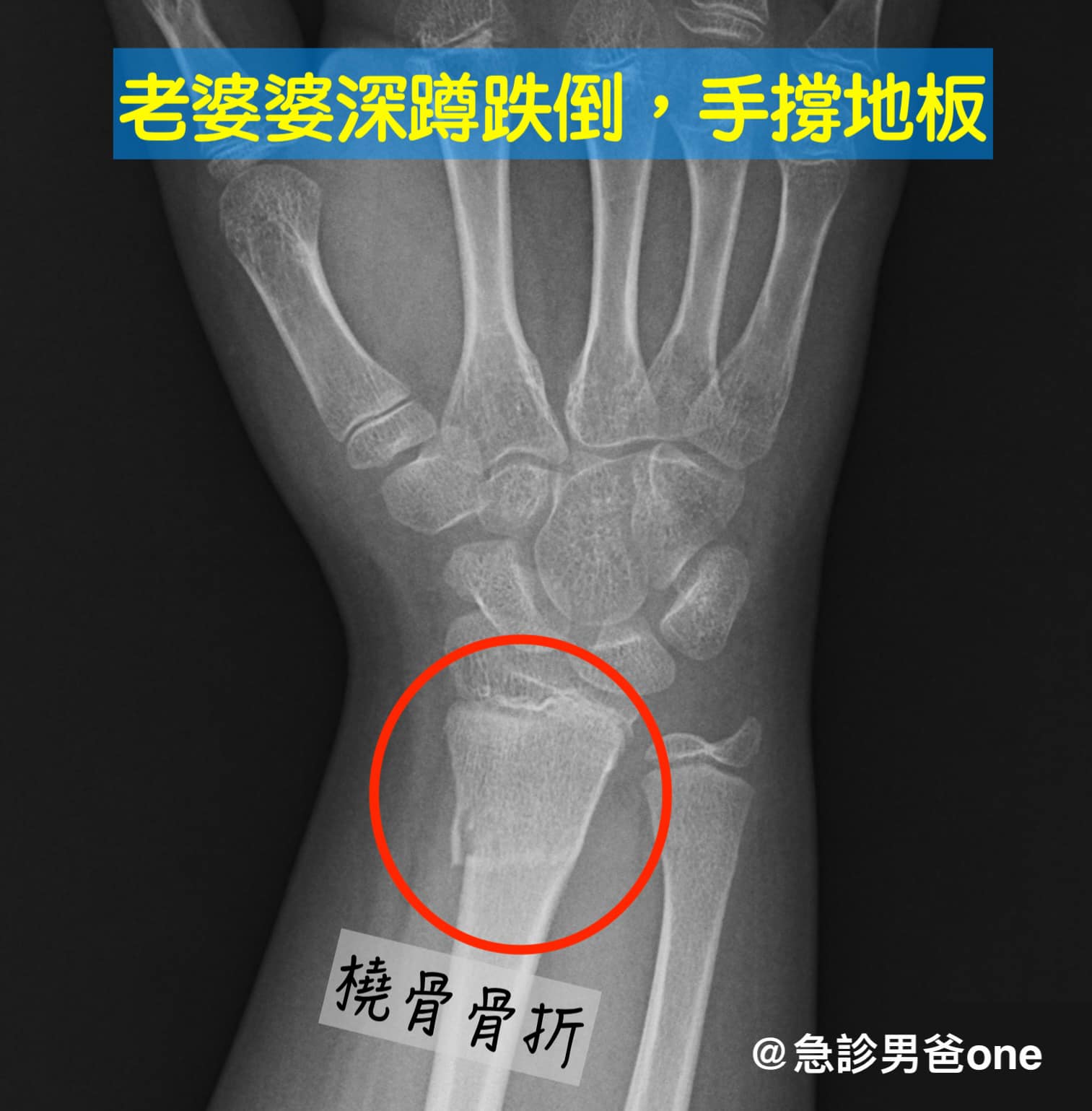 80多歲阿嬤做深蹲,不慎骨折須開刀。(圖/翻攝自急診男爸one臉書)