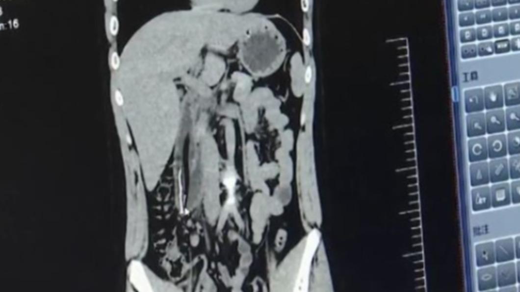 腹痛2天驚見「20cm牙刷」!陸男糗吞下肚 腸遭卡死險穿孔