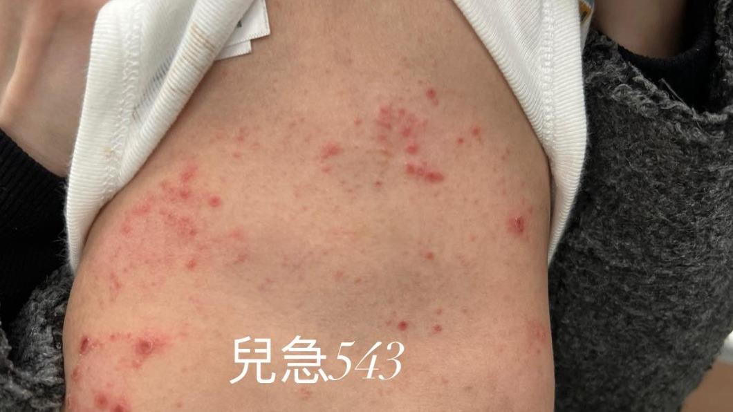 打過疫苗也難防　1歲童染克沙奇腸病毒口腔潰瘍全身濕疹