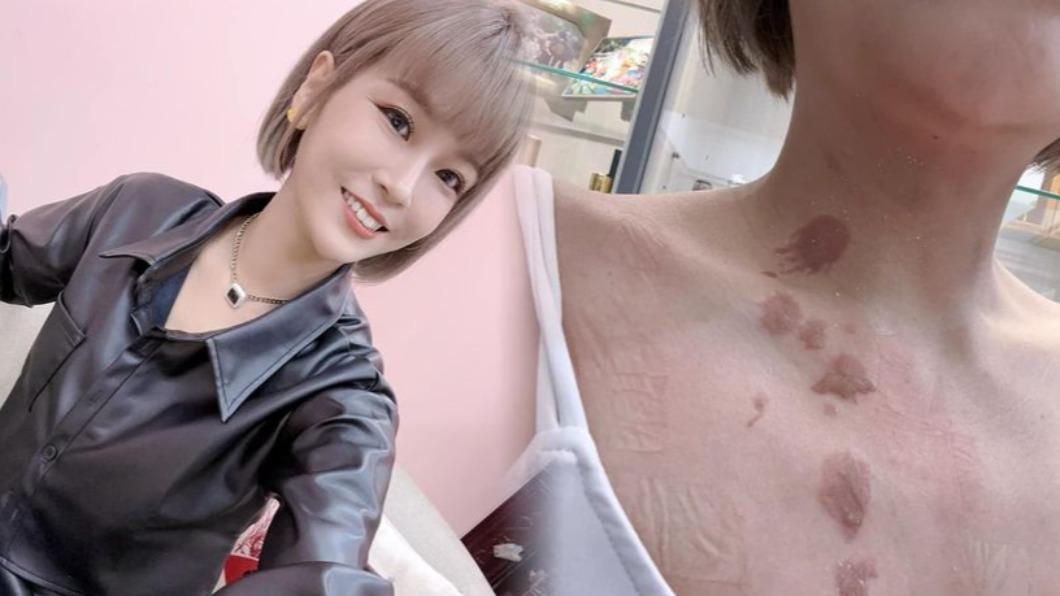 李明珊直播意外!遭熱油濺傷「險毀容」 曬大片黑疤:各行各業都辛苦