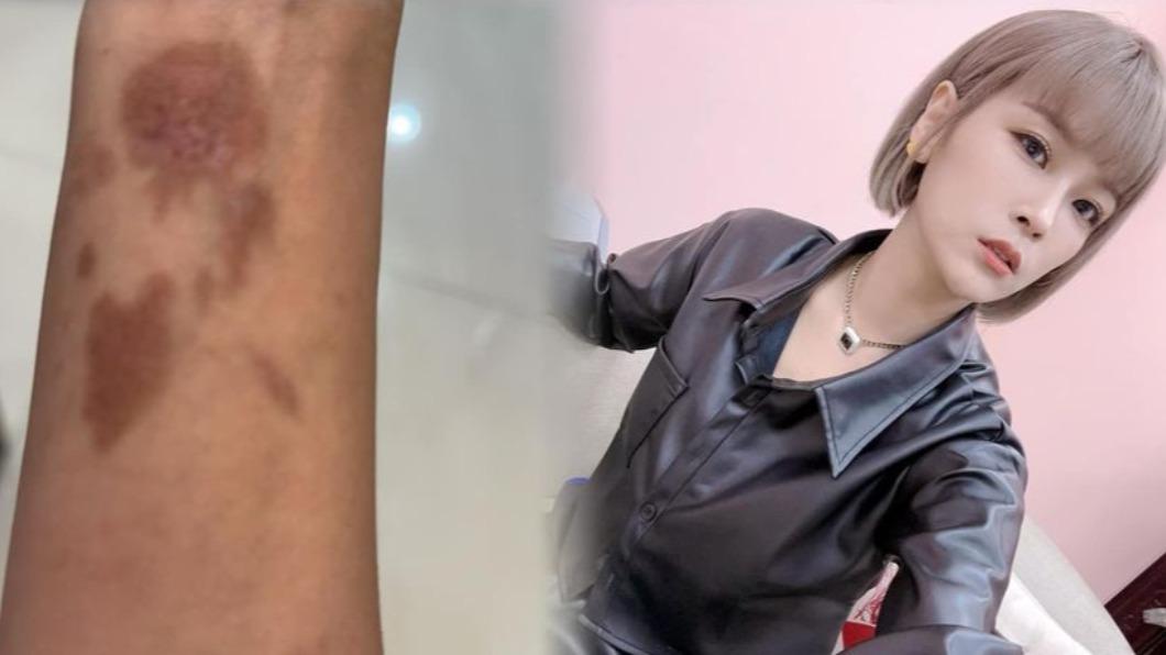李明珊除了胸口有傷,手腕之前也出事。(圖/翻攝自樓頂揪樓下臉書)