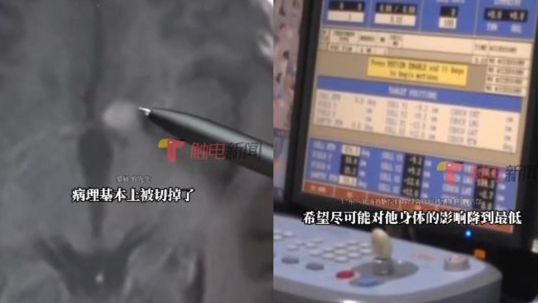 少年就醫檢查後發現,腦部長了一顆腫瘤,必須靠化療控制病情。(圖/翻攝自微博)