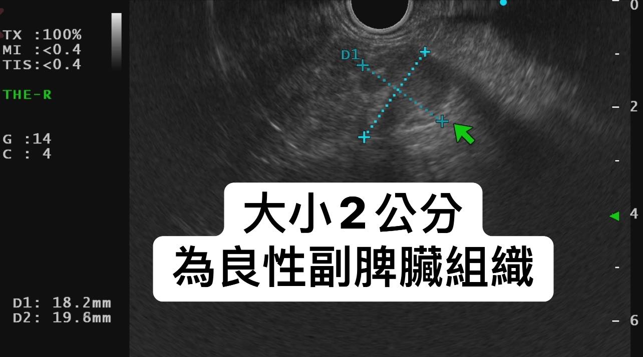 男子胰臟尾部檢查出1~2公分大腫瘤，為胰臟內副脾臟。（圖／翻攝自林相宏臉書）
