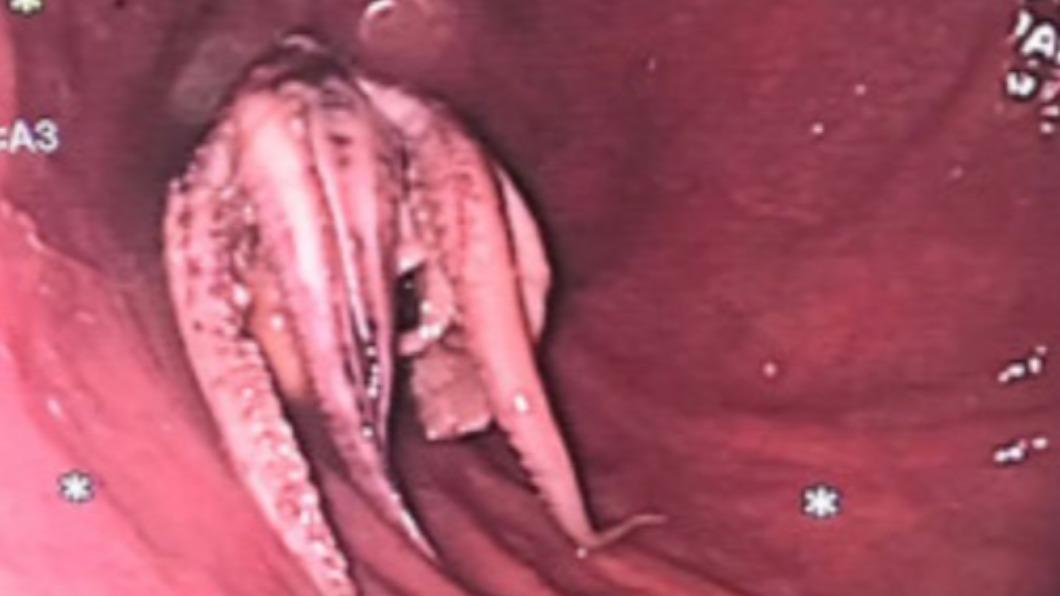 食道挖出「整隻章魚」！他吞嚥困難就醫　觸手卡死畫面曝