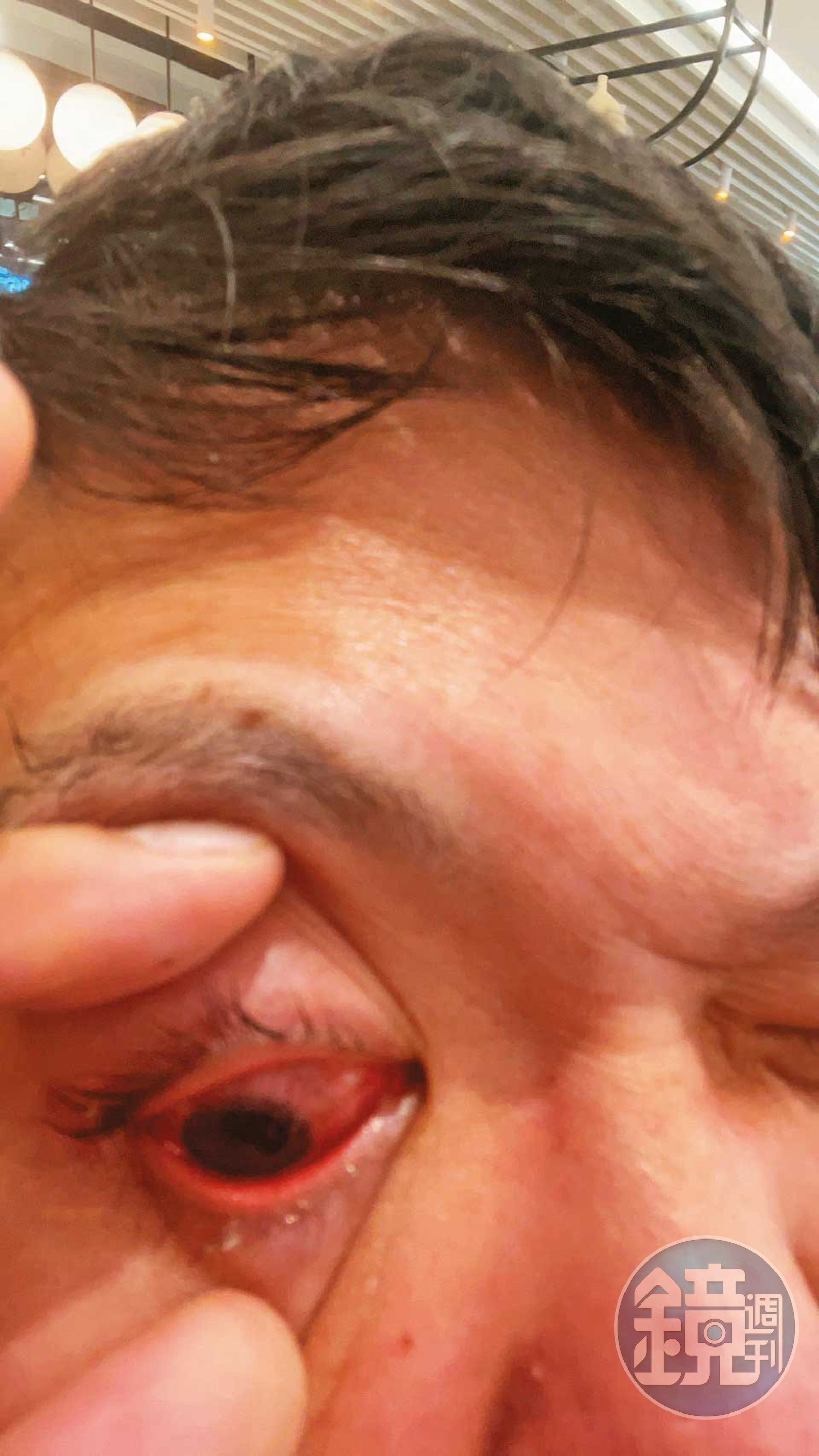 被警方壓制過程中,黃先生的眼角膜破裂受傷。(圖/鏡週刊)