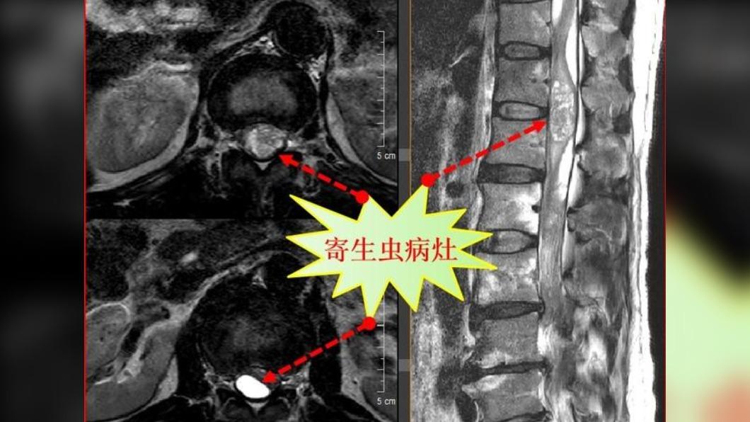陸男「生吞蛇膽」怪病纏身 醫驚見脊髓整坨寄生蟲病灶