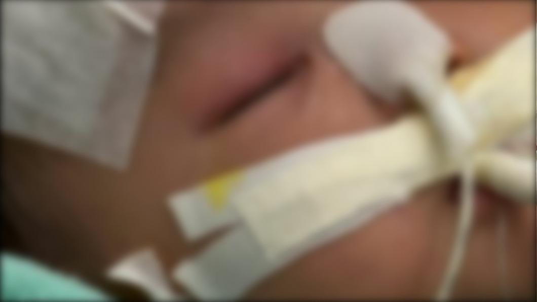 小雪兒腦出血嚴重,手術將頭骨取出。(圖/翻攝自夠薑子 呂校長 l 貓貓校監 l臉書)