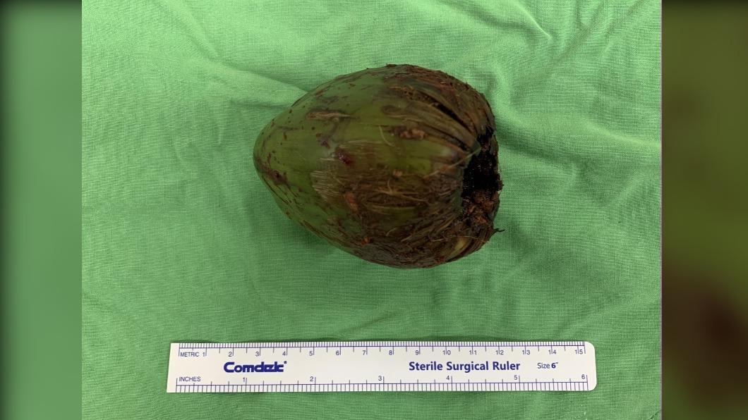 求刺激？高雄男「椰子塞肛門」痛2天就診　醫驚：膀胱險爆炸