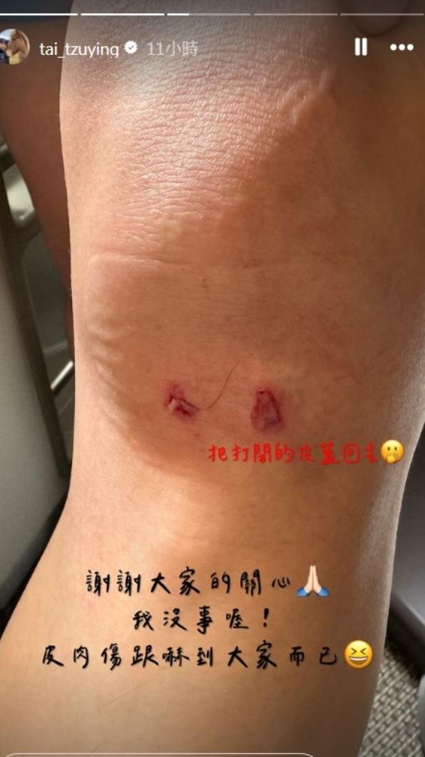 戴資穎PO出傷勢照。(圖/翻攝自戴資穎IG)