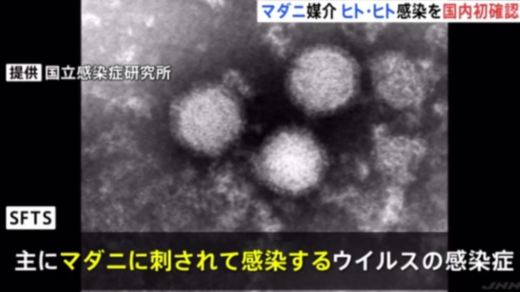 日本首例蜱媒傳染病人傳人　醫被病人染「發熱伴血小板減少綜合症」