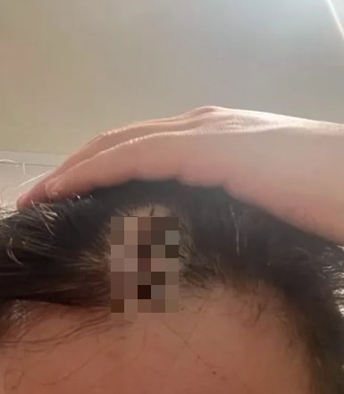 女子的頭部縫了5針。（圖／翻攝自微博）