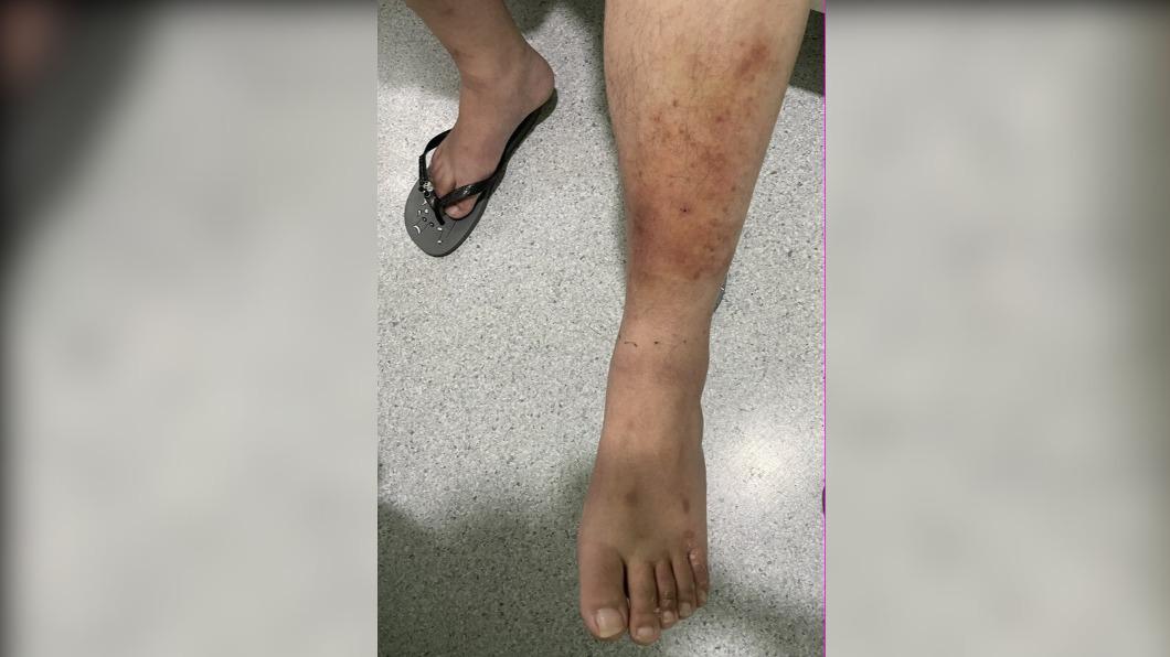 噁！男子染香港腳不就醫　小腿「腫像豬腳」險遭截肢　