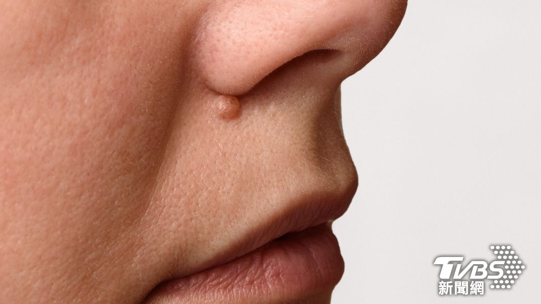 鼻翼邊緣有痣的話代表這個人天生勞碌命格。(示意圖/shutterstock達志影像)