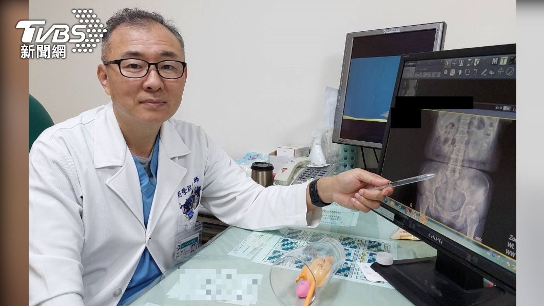 婦人子宮脫垂八年  引發腎衰竭敗血症