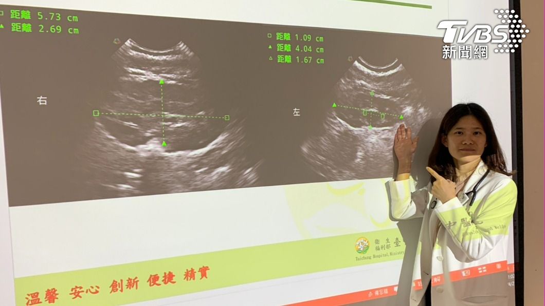 男嬰的腎臟超音波顯示雙側輕微水腎。(圖/TVBS)