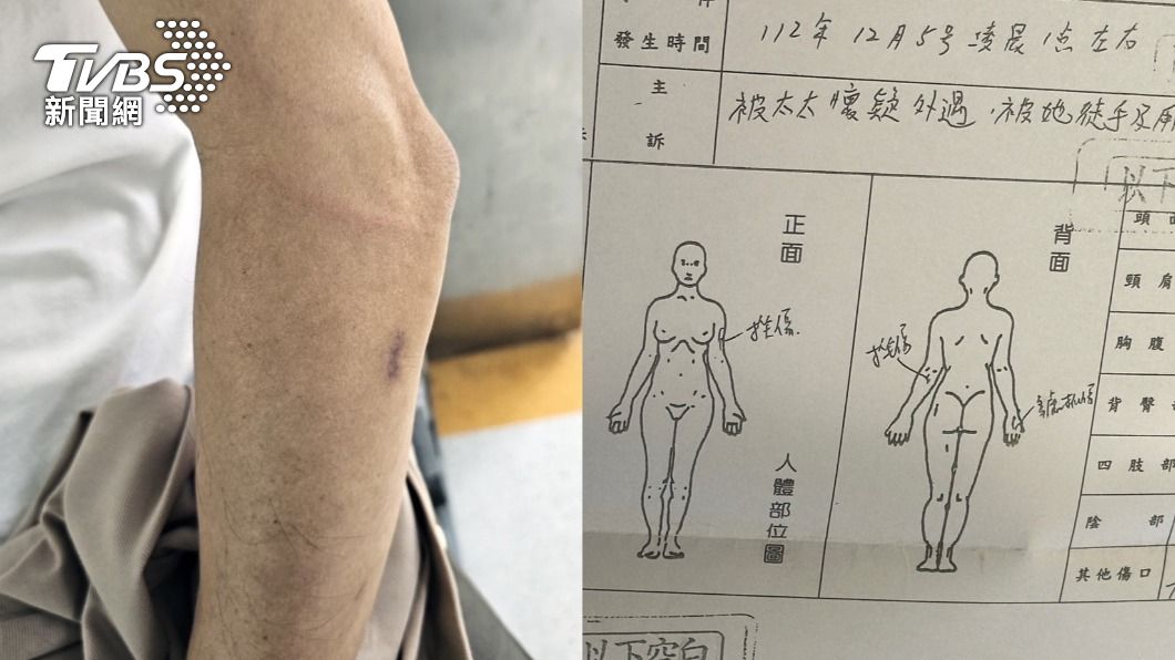 倪宗亨拿出驗傷單,指出遭到家暴的才是自己。(圖/當事人提供、陳佳宜攝)