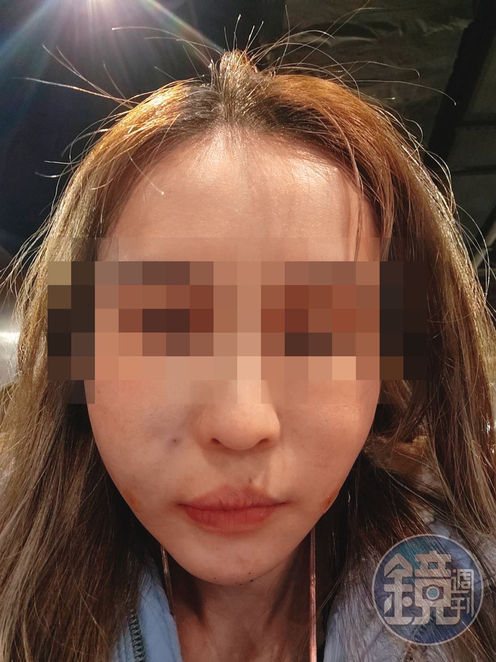 術後整張臉腫到像豬頭，讓C小姐痛不欲生。（圖／鏡週刊讀者提供） 