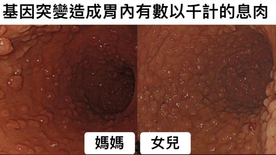 妹子胃裡爆長「數以千計息肉」!醫嚇瘋:和她媽一模一樣