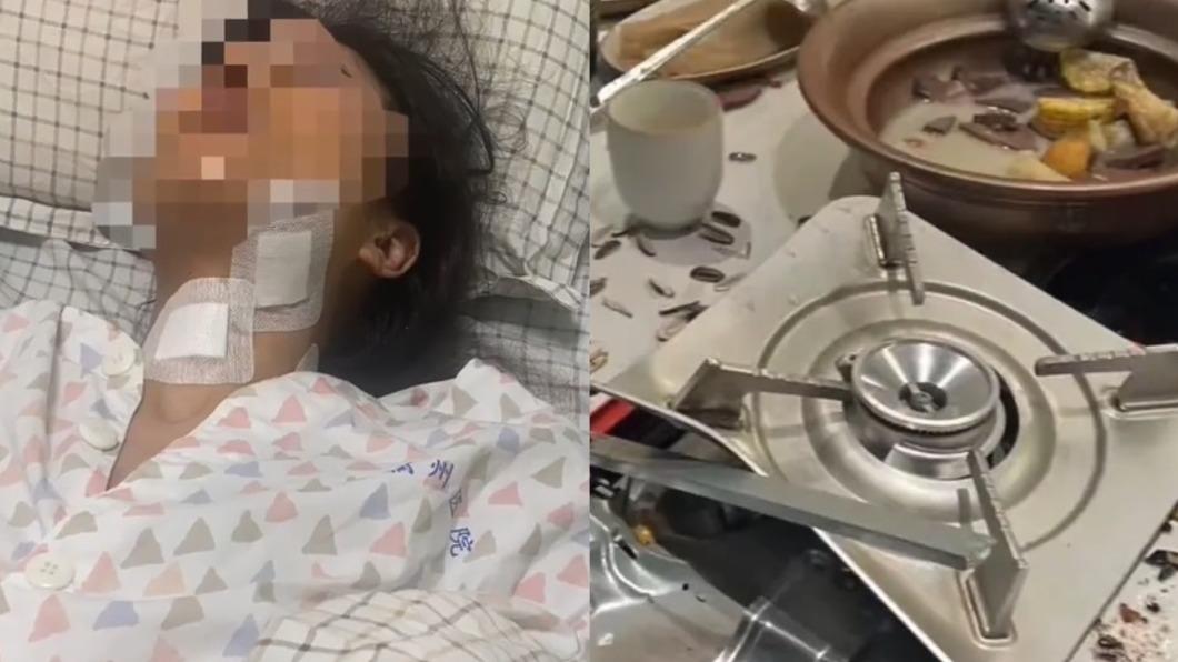 卡式爐上桌突爆炸!陸女全身縫50針 慶生一半「左眼慘失明」