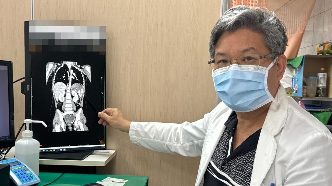 女童脾臟嚴重破裂。(圖/李綜合醫院提供)