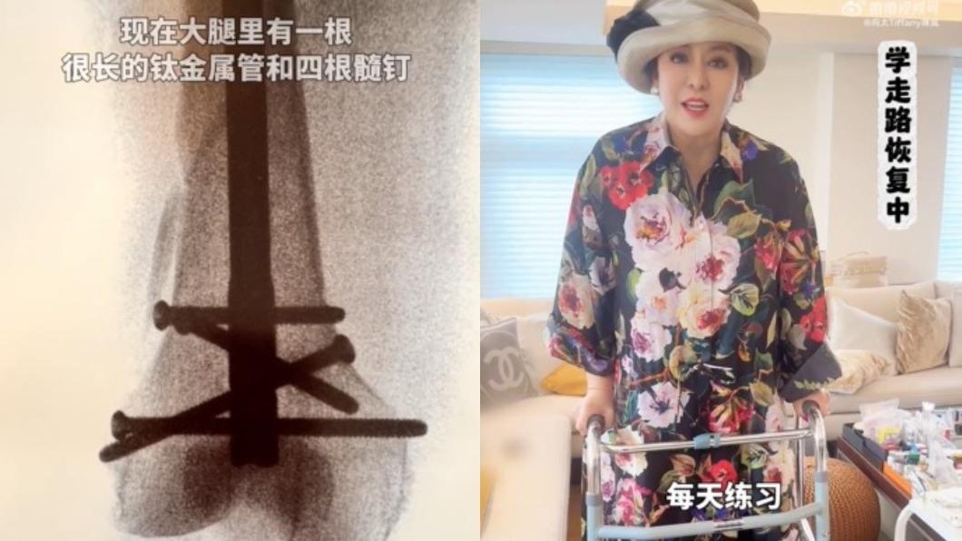 向太親自曝光目前傷勢。(圖/翻攝自向太微博)