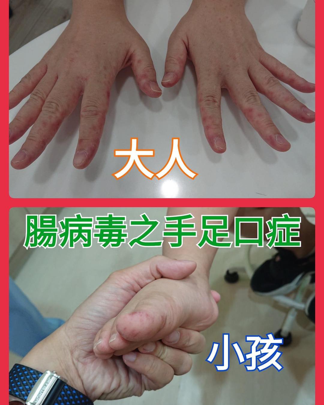 腸病毒來勢洶洶,醫師提醒大人小孩都需注意。(圖/翻攝自阿包醫生陪你養寶包 - 小兒科巫漢盟醫師 臉書)