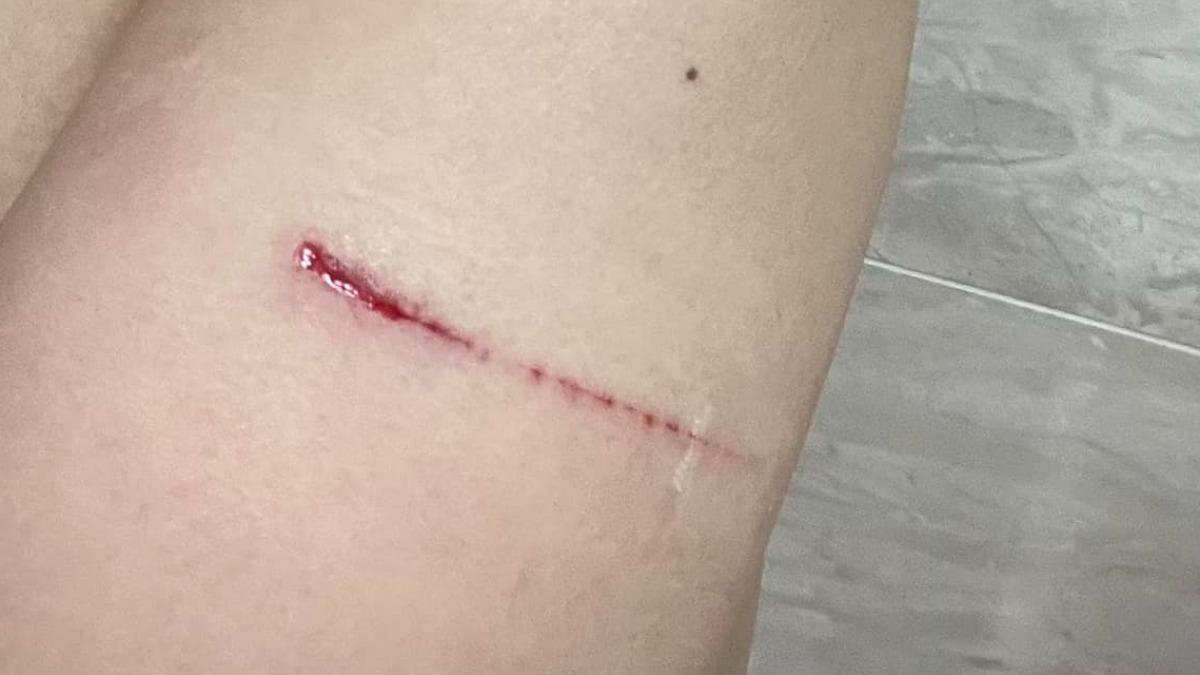 李蒨蓉曬出手臂上一道長長的血痕。(圖/翻攝自李蒨蓉臉書)