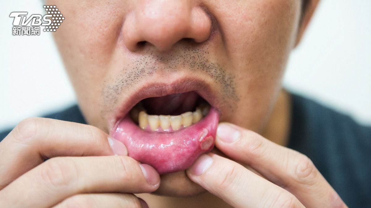 嘴破若超過4周未癒合,要當心可能是口腔癌。(示意圖/shutterstock達志影像)