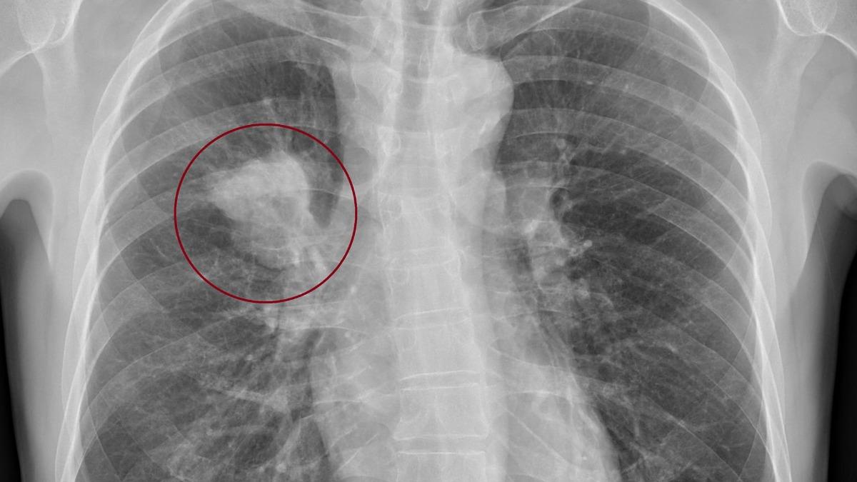 醫一摸完蛋了！50歲男「脖子一粒硬硬的」驚罹癌　見X光不敢信