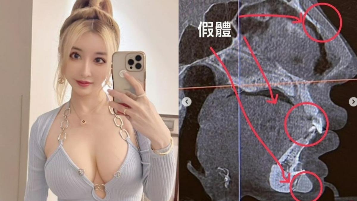 情色教主臉整19次！出國安檢逼逼叫　照X光驚見「下巴3公分釘子」