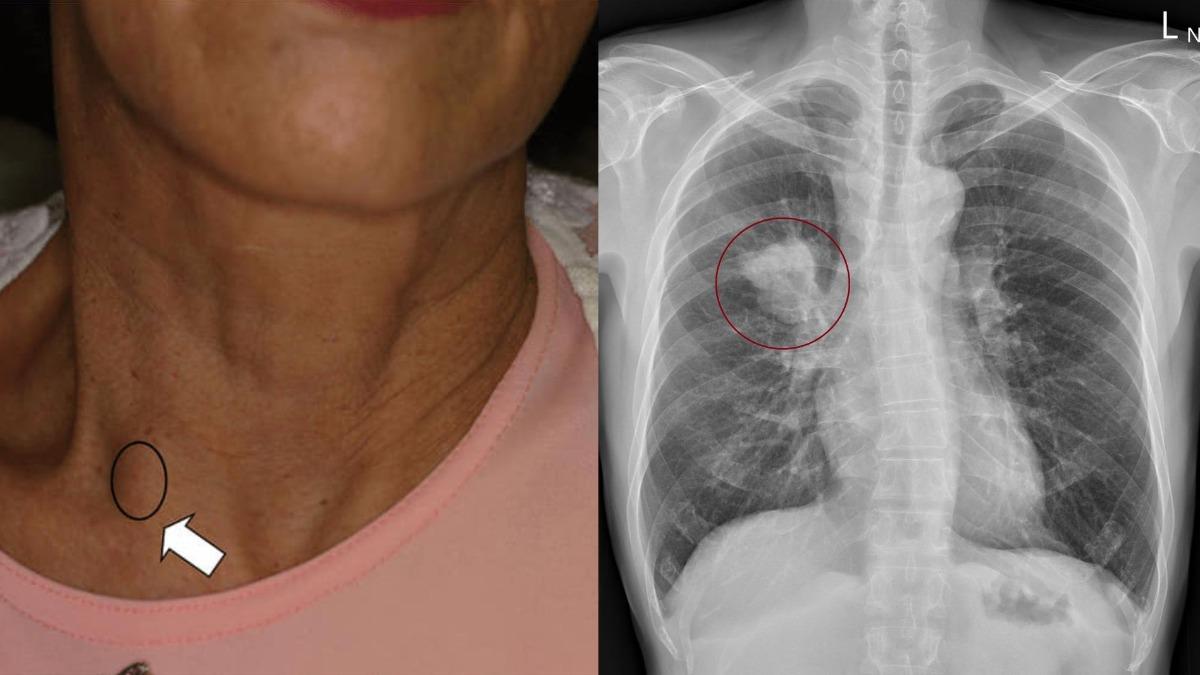 50歲男脖子「一顆硬硬的」竟是癌! 醫示警:痛不痛是關鍵