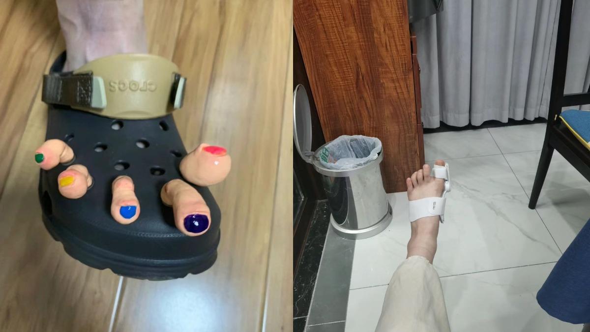 洞洞鞋的尺寸若是錯誤可能出現拇指外翻、大腳趾關節突出等問題。(圖/翻攝自小紅書)