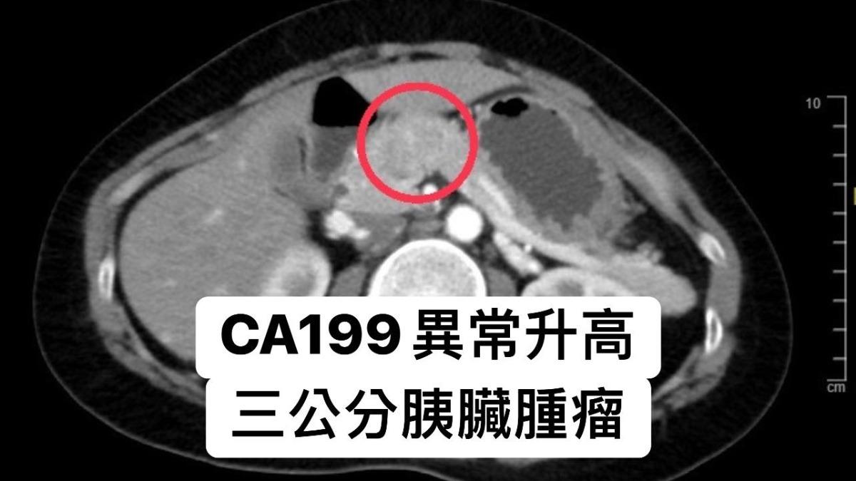 40歲女不菸不酒!照斷層驚見腫瘤「恐罹癌王」 7類人快篩檢