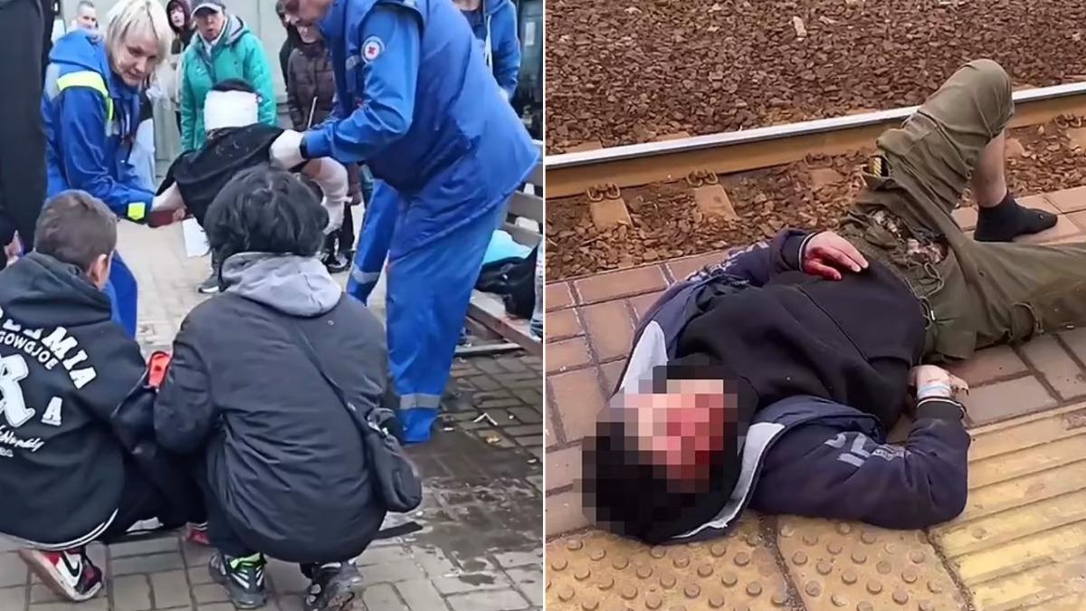 少年全身多處嚴重燙傷，生殖器更是被形容為「燒焦」。（圖／翻攝自East2West News）