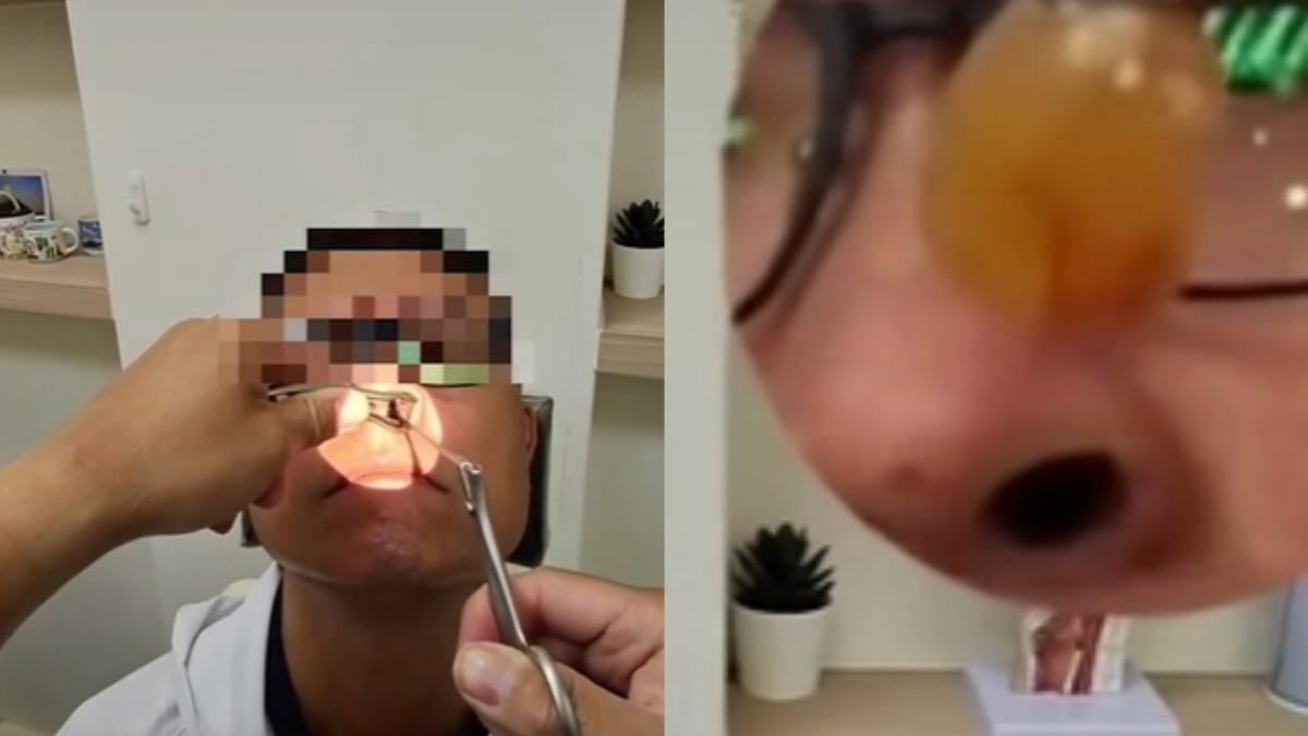 他鼻塞半年好不了!鼻孔悚夾出「整顆荔枝肉」 醫驚:卡死了