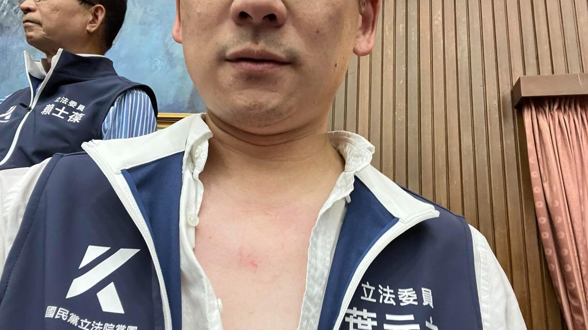 葉元之爆遭攻擊!「傷勢照曝光」怒吼有夠扯:民進黨暴力黨
