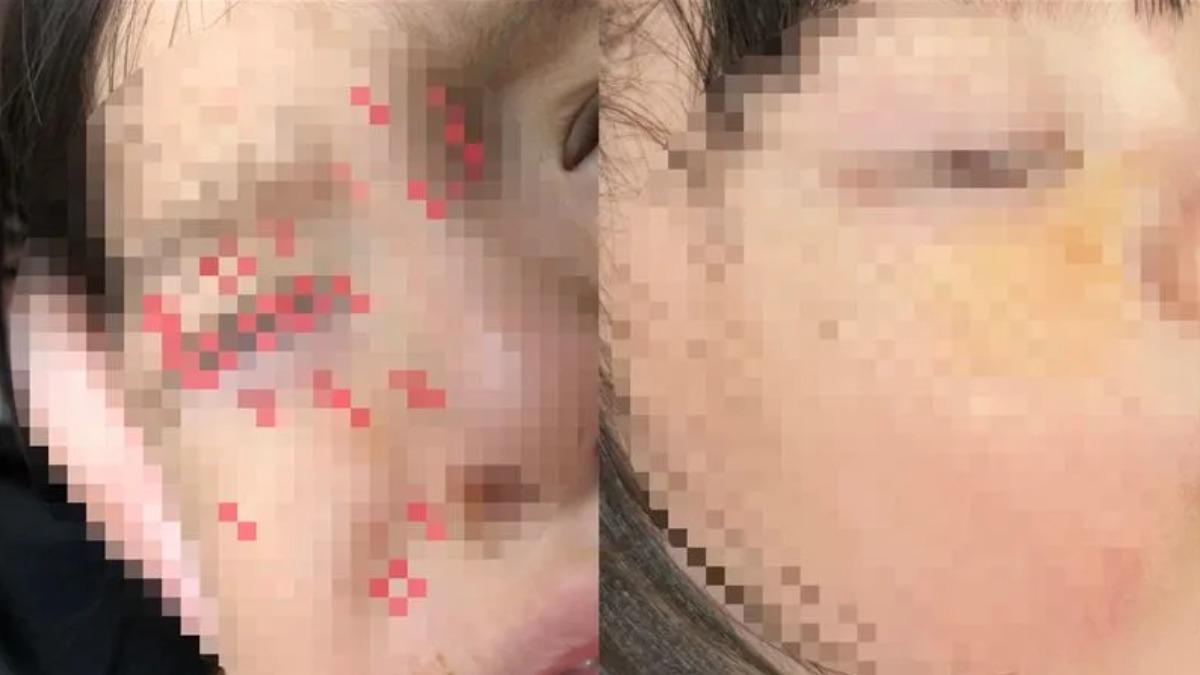 信義區突遭鵝攻擊!女童臉部「大片瘀血」 飼主開溜媽氣炸
