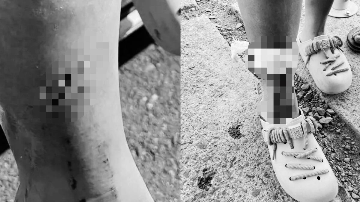 屏東看水豚突被咬!她「右小腿留2洞狂冒血」 業者回應了