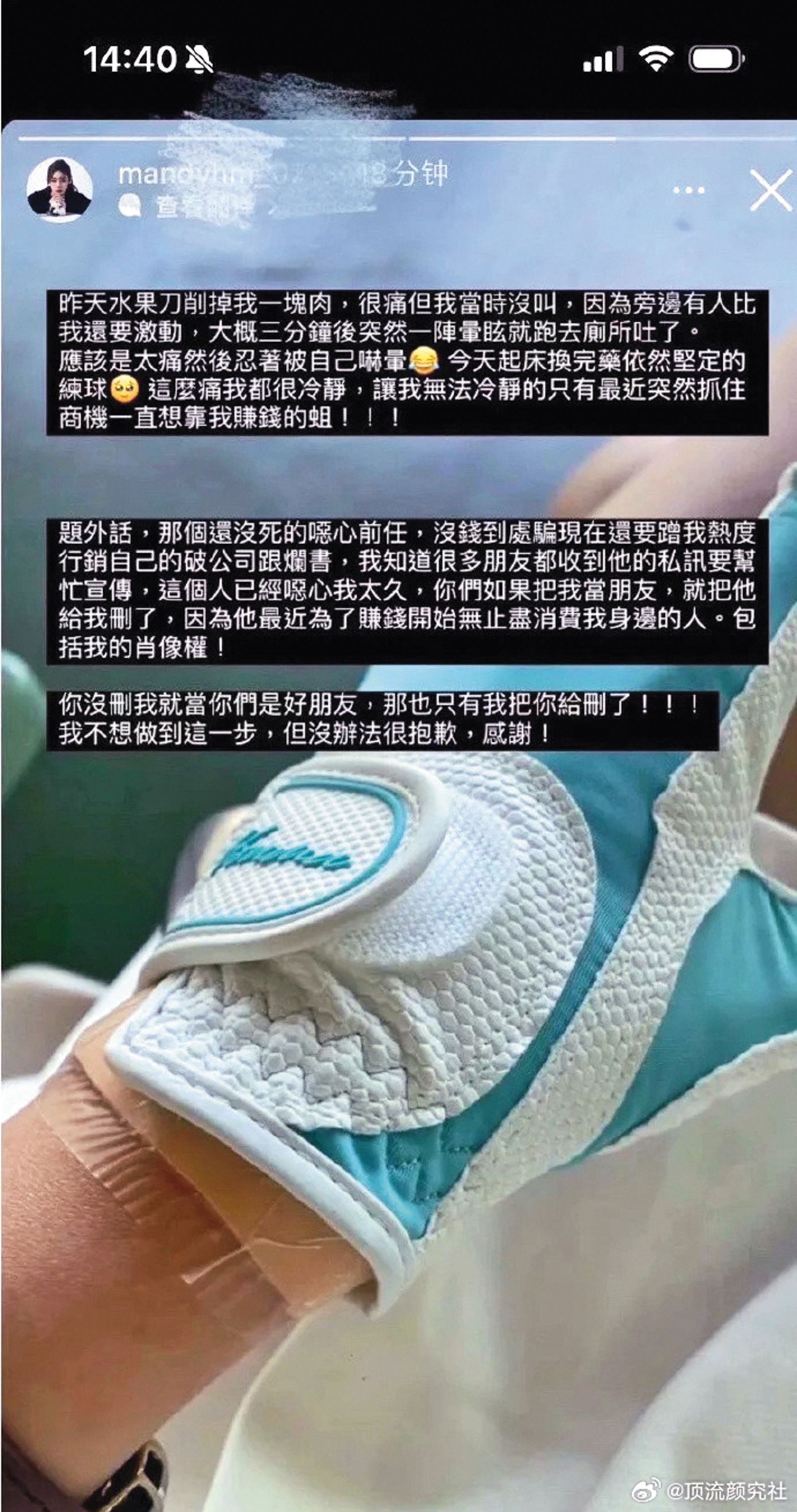 日前汪小菲未婚妻Mandy在網路上發文,除曬出受傷的手部照片,也開罵前任消費她。(圖/翻攝自微博)