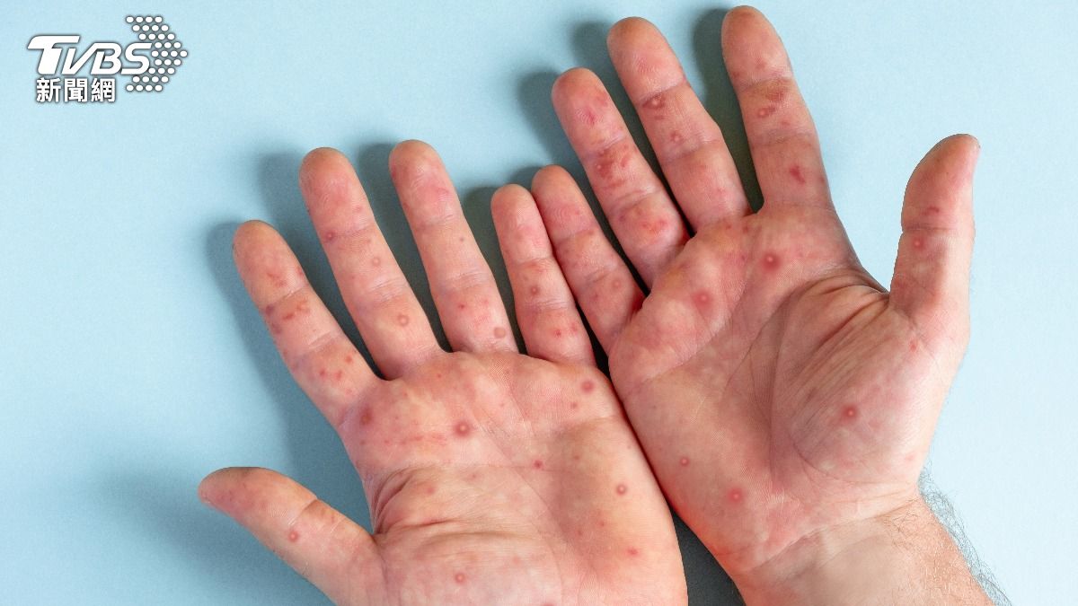 腸病毒破500班停課!「這年齡」死亡率最高 當心重症前兆