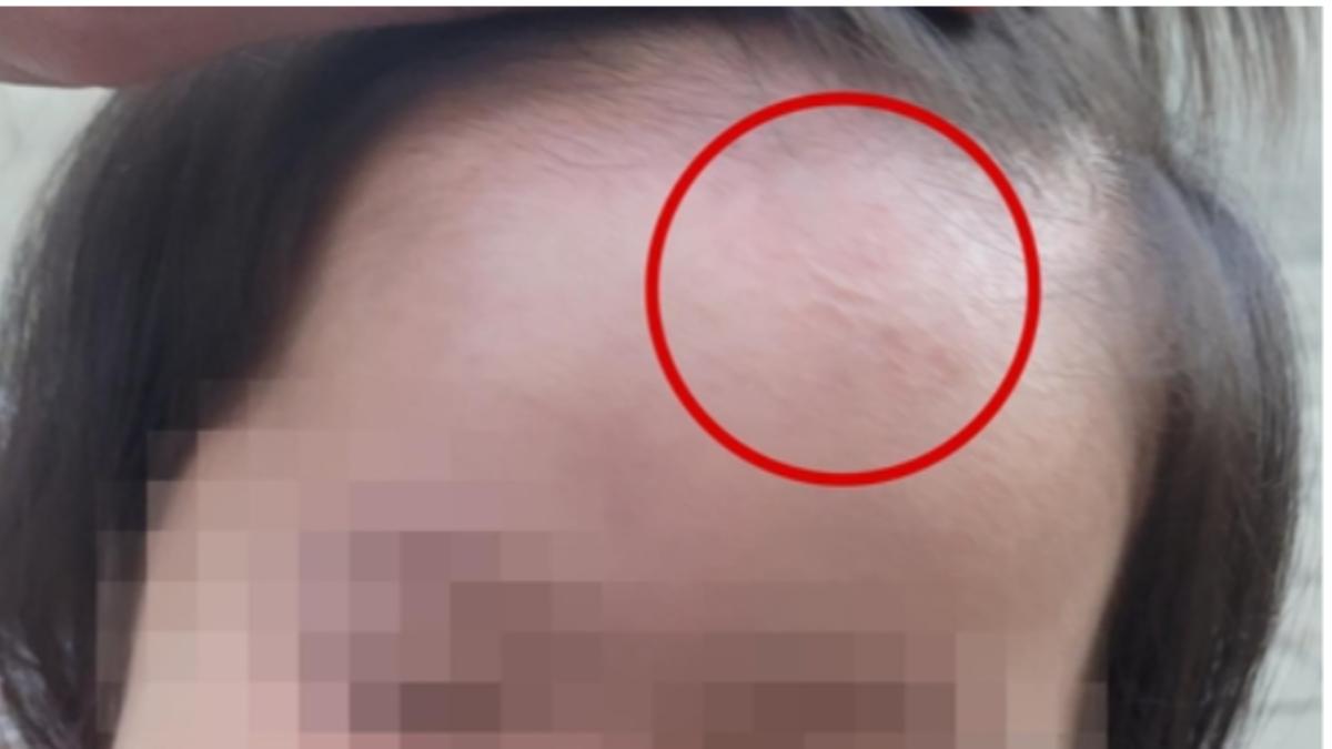 醫院指出,女嬰的疤痕會隨成長越來越大。(圖/翻攝自韓聯社)