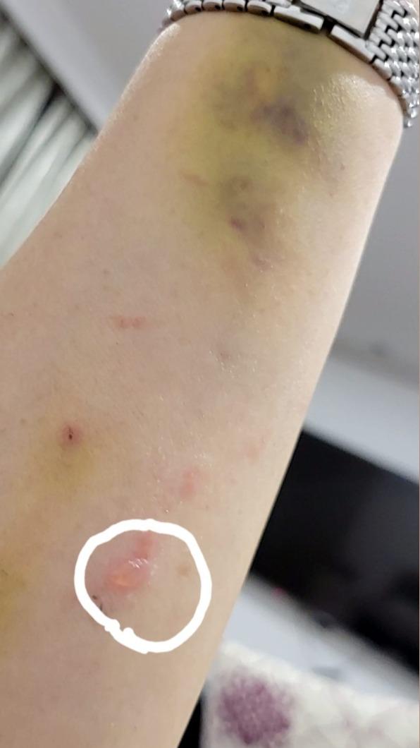 小彤輕輕一碰就瘀青破皮起水泡。 (圖/翻攝自小彤臉書)