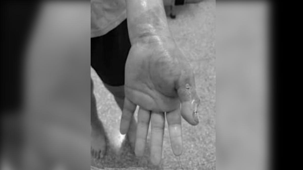 扯!雲林小六妹「手指被打變形」 補習班師道歉:她不交作業