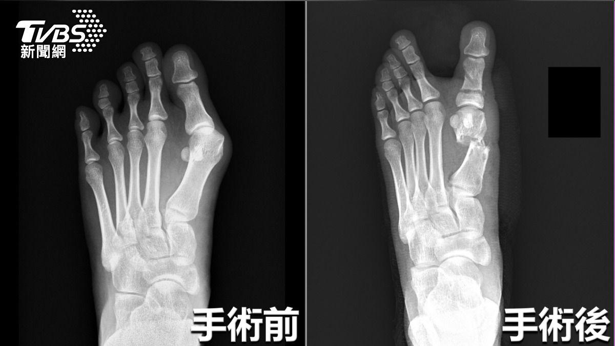 小模穿高跟鞋整天紅腫痛翻 醫師一照「大姆趾卡第二趾下」