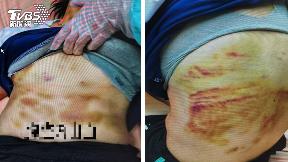 惡男擀麵棍毆妻！害胸腔出血、視力只剩0.1　網友拳頭全硬了