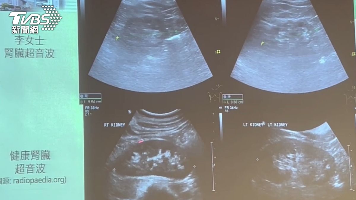 李婦患有慢性腎臟病第五期,腎絲球過濾剩下8分。(圖/林冠丞攝)