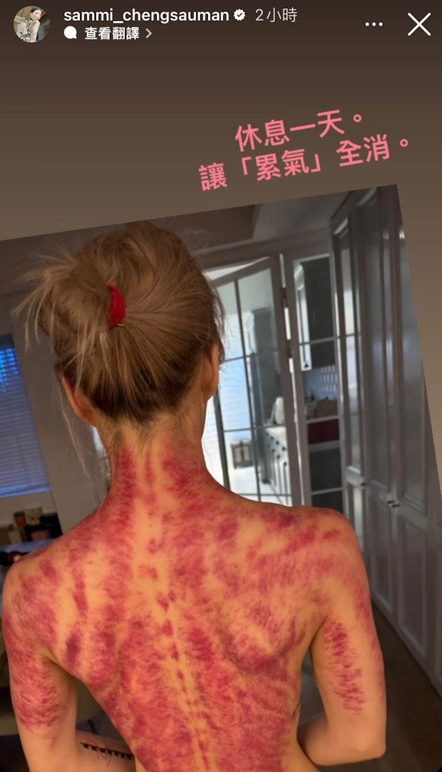 鄭秀文去刮痧，背上痕跡明顯。（圖／翻攝自sammi_chengsauman）